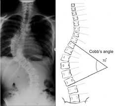Mind Body Detective Scoliosis Cobb Angle