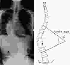 Mind Body Detective Scoliosis Cobb Angle