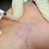 $250 per treatment.
