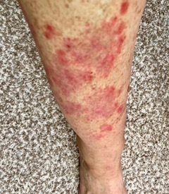 Psoriasis patches on leg June