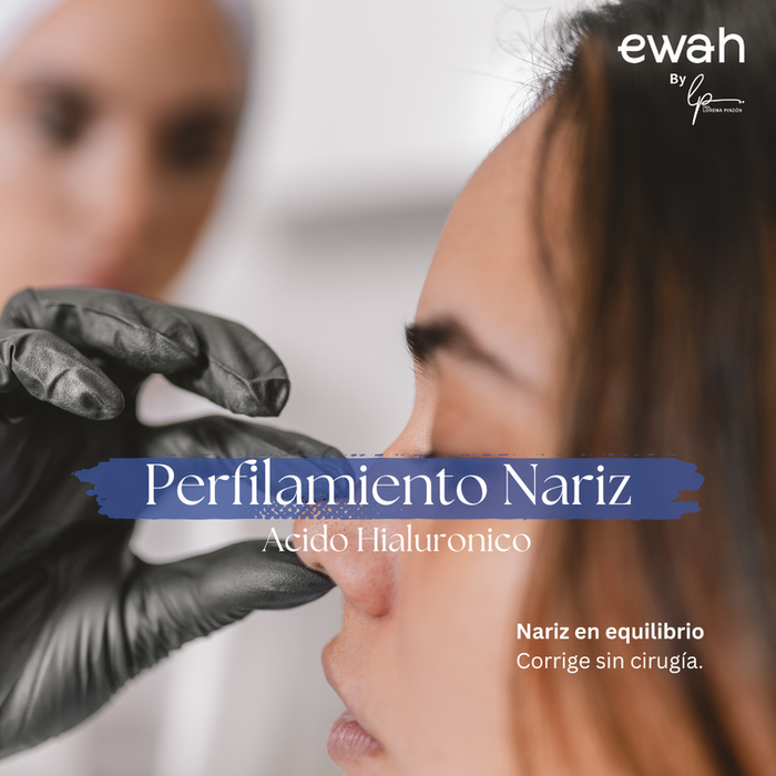Perfilamiento de Nariz, Rinoplastia,sin cirugia con acido hialuronico, en Bogota