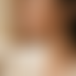 Perfilamiento Mandibular con Ácido Hialurónico en Bogotá