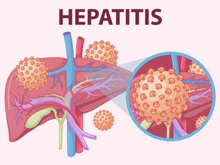 What is Hepatitis-A? and what are the causes?