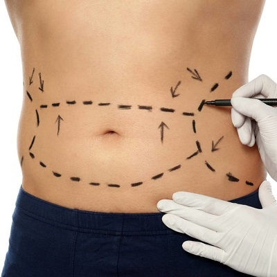 شفط الدهون لإزالة الذقن المزدوجة