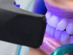 Elevate Your Confidence: Nano Teeth Whitening Treatments in Dubai