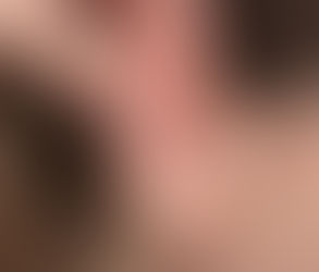 إعادة تشكيل الأذن لتحسين مظهرها التجميلي