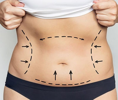 هل يمكن لعملية شفط الدهون أن تقلل من محيط الخصر؟