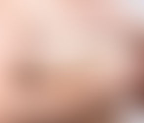 تصغير الثدي لتحسين استقامة القوام