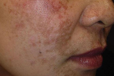 Hyperpigmentation | Revitalise