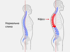 Кіфоз 