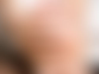 Hallazgo de la UNAM, clave para conocer el desarrollo de cáncer de piel en México