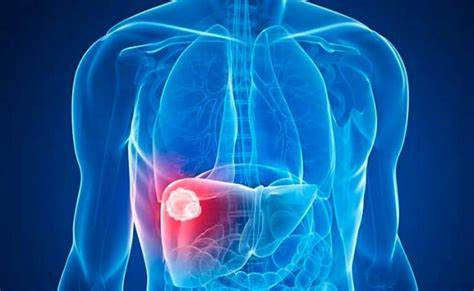 Síndrome metabólico, nuevo factor en aumento de cirrosis hepática: investigadoras del IPN