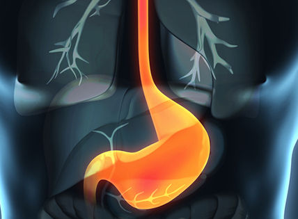 Hallan impacto del reflujo gastroesofágico