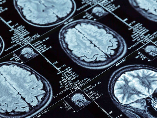 Hemorragia cerebral, reto de conocer sus secuelas y daños