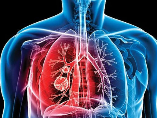 Recortes de Estados Unidos a lucha contra tuberculosis pueden provocar a 2 millones de muertes