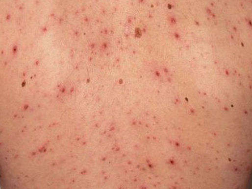 Brotes de sarampión en las Américas: OPS insta a reforzar la vacunación y vigilancia