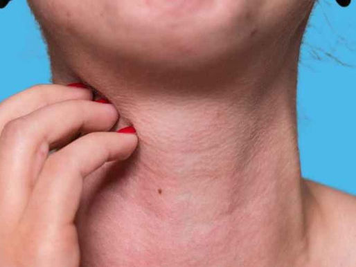 4 de cada 10 mexicanos padecen alergias