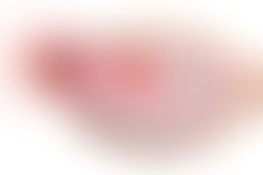 Síndrome de ovario poliquístico, común entre las mujeres mexicanas