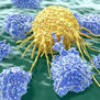 Rusia desarrolla fármaco para tratar formas agresivas de cáncer de mama y ovario
