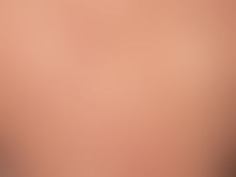 Situación del sarampión en México