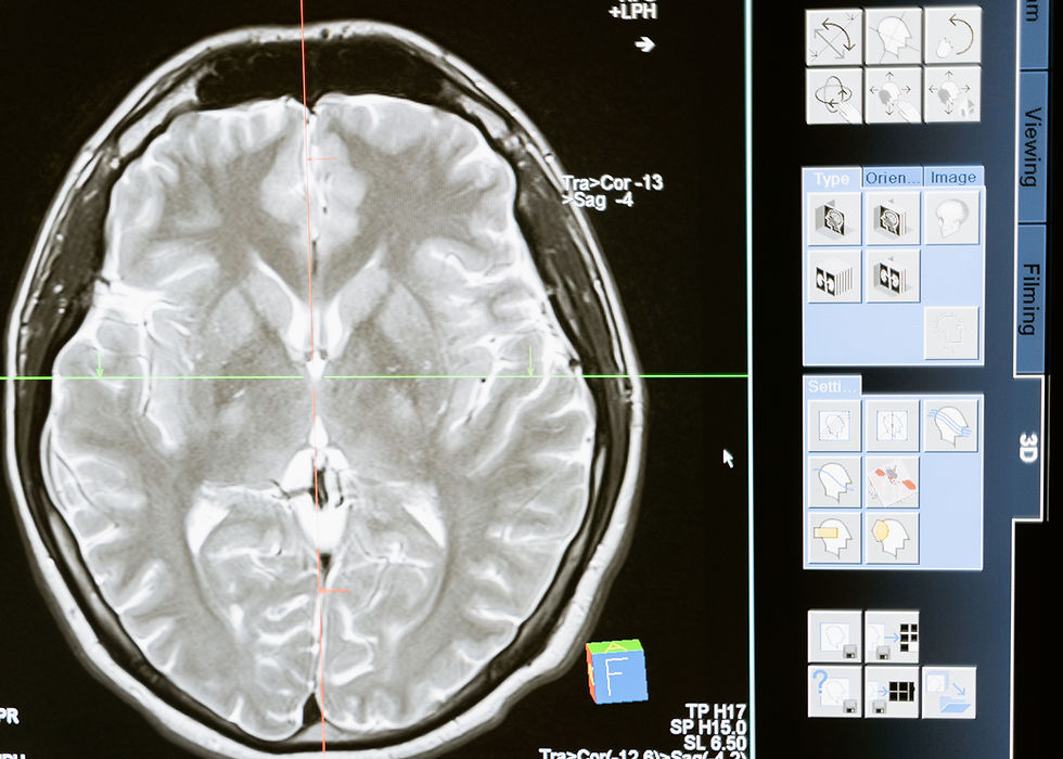 Vinculación de la genética de la dislexia con cambios en la estructura cerebral