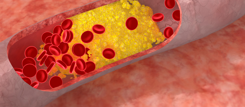 Un nuevo fármaco reduce drásticamente los niveles de colesterol