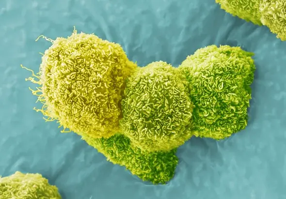 Vacuna de ARN logra un primer éxito contra el cáncer de páncreas, el tumor más letal