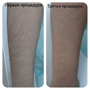 Гелевая эпиляция курс