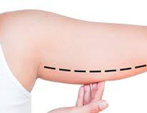 Arm Lift (Brachioplasty)