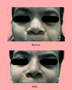 Rhinoplasty Andheri