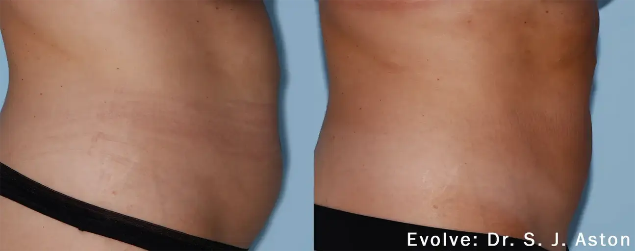 evolve-before-after-dr-sj-aston-preview-1.webp