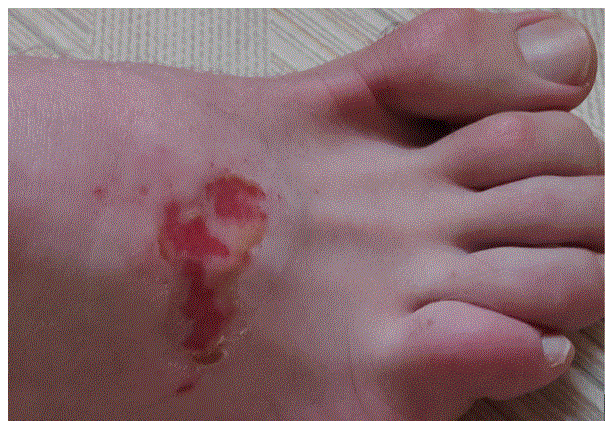 Blessure pied.GIF