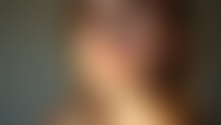 Understanding Melasma:  Understanding The Triggers and How Alma Clear Lift Laser with  A Power House Trio Can Help Treat Your Skin Beautifully