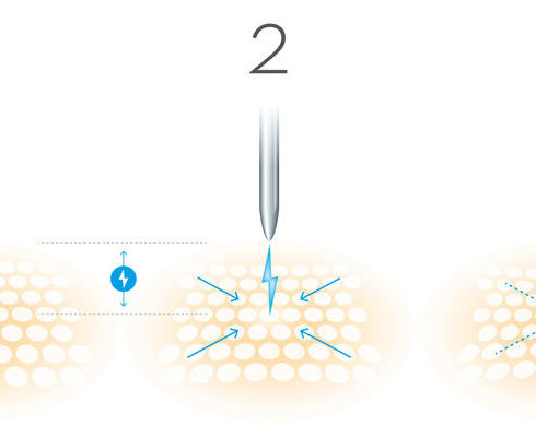PB-FIBROBLAST-Plasmareaktion-01.jpeg