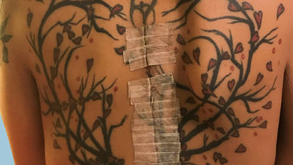 Image of the author post surgery illustrating the extent of the spinal procedure