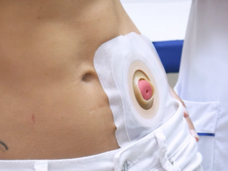 Ostomia: confira dicas para o manuseio correto do procedimento que salvou a vida de Preta Gil