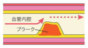 心臓血管研究所付属病院 労作時狭心症