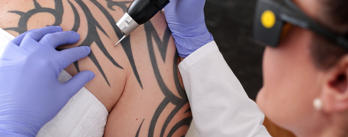 Tattoo Removal