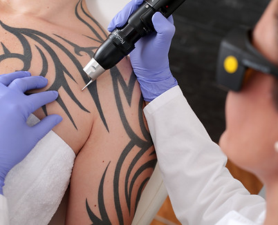 Tattoo Removal