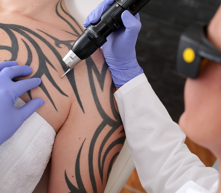 Tattoo Removal