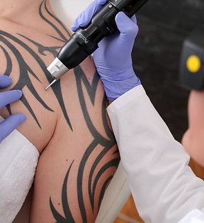 Tattoo Removal