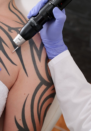 tattoo Removal