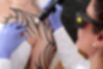 La eliminación de tatuajes