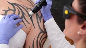 Como remover a minha Tatuagem?