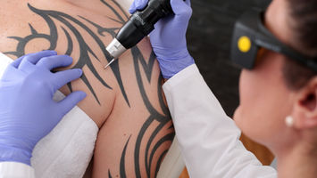 Laser Tattoo Removal