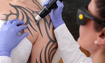 Tattoo Removal