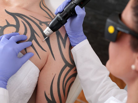 Como remover a minha Tatuagem?