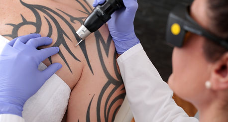 Tattoo Removal