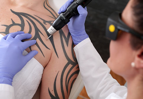 Tattoo Removal Process
