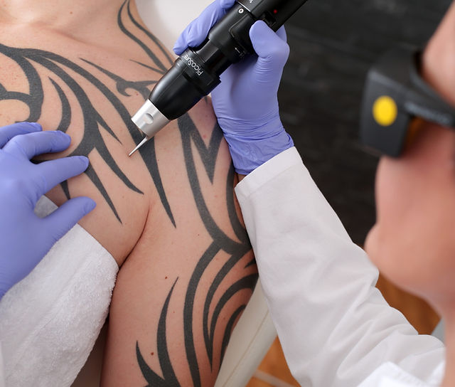 Laser removal of tattoos and PM | LASER DOCTOR